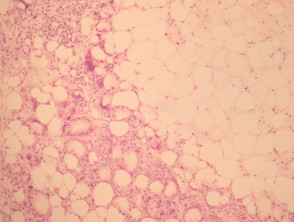 Subcutaneous fat necrosis of the newborn pathology