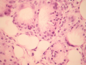 Subcutaneous fat necrosis of the newborn pathology