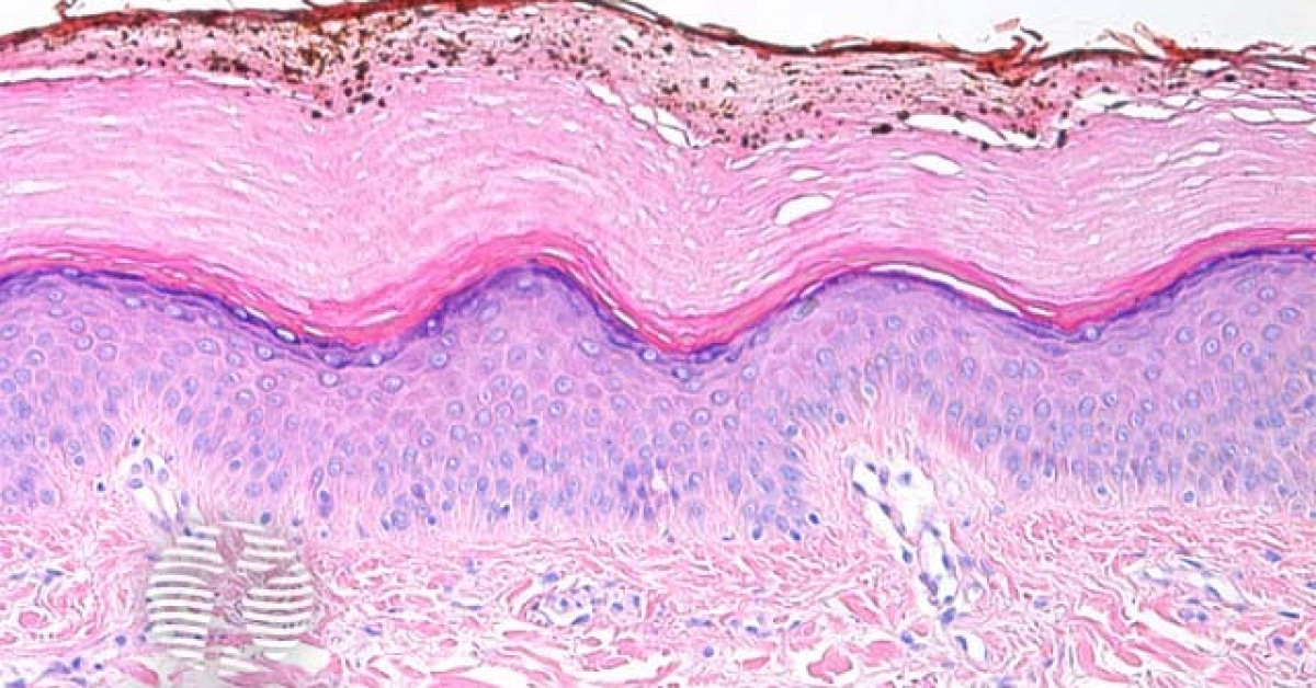 Silver nitrate pigmentation pathology image