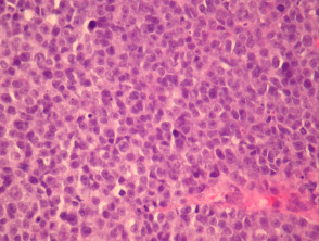 Melanoma pathology: Small cell melanoma