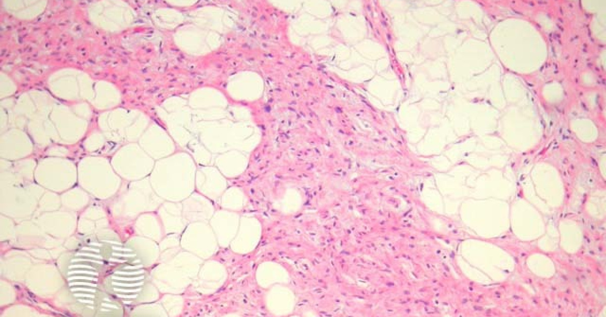 Spindle cell lipoma pathology image