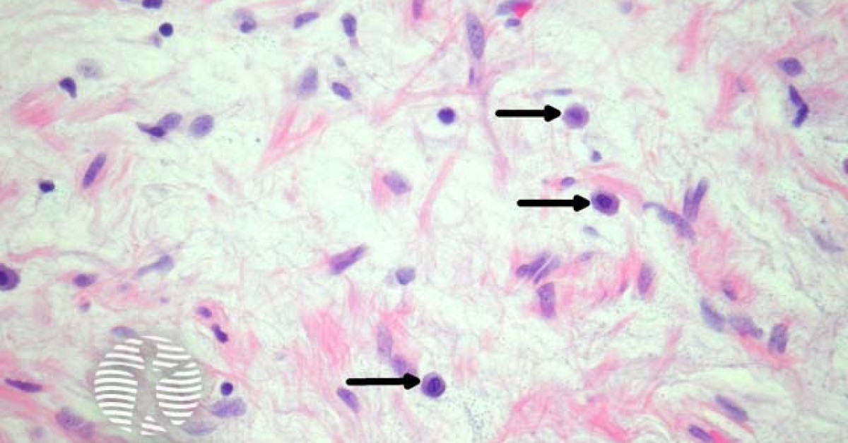 Spindle cell lipoma pathology image