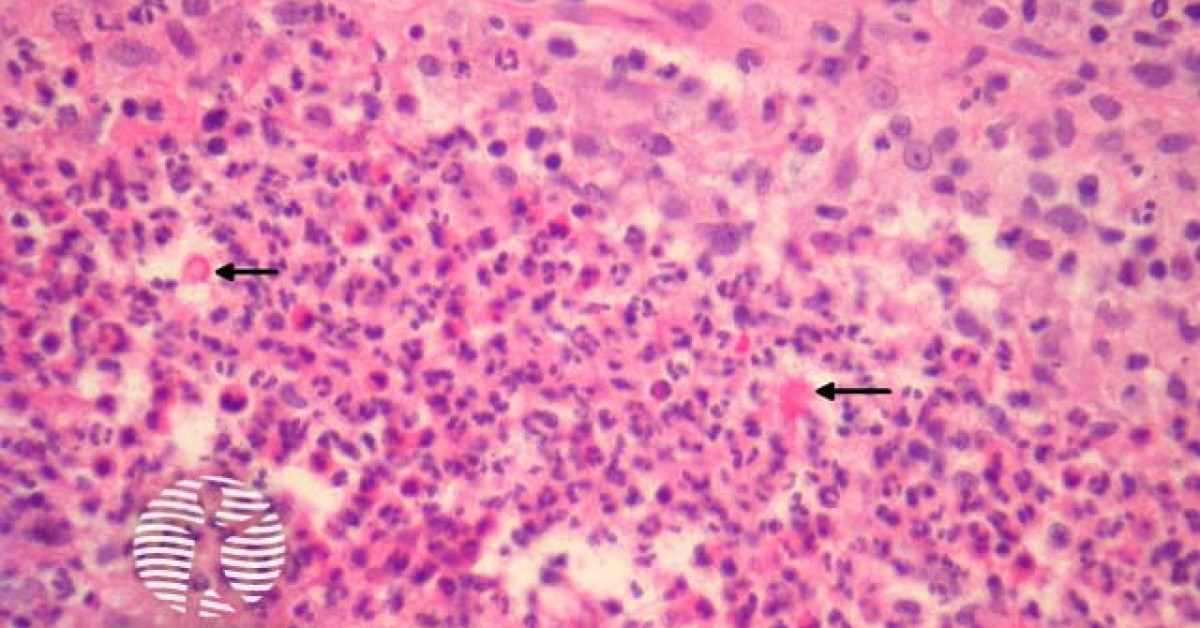 Sporotrichosis pathology image