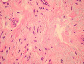 Superficial acral fibromyxoma pathology