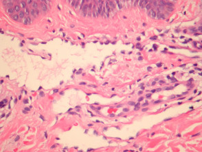 Targetoid haemosiderotic haemangioma pathology
