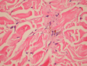 Targetoid haemosiderotic haemangioma pathology