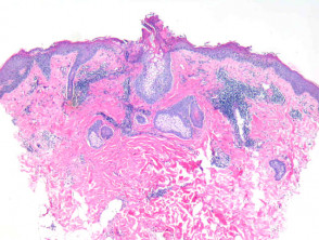 Tinea unguium Fig 10: Tinea corporis and tinea unguium) (Ringworm