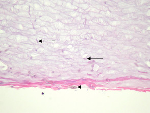 PDF] Spontaneous cure in a case of Tinea nigra.