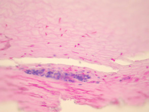 Onychomycosis pathology