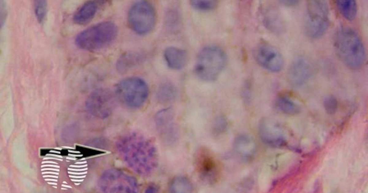 Toxoplasmosis pathology image