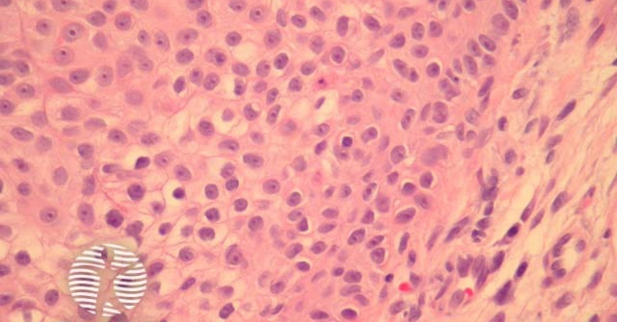 DermNet® - Trichilemmal carcinoma pathology image