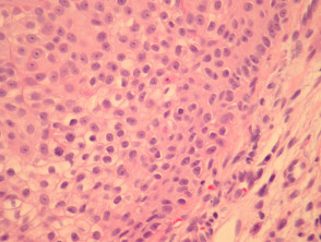 Trichilemmal carcinoma pathology
