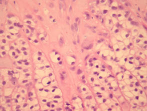 Trichilemmal carcinoma pathology