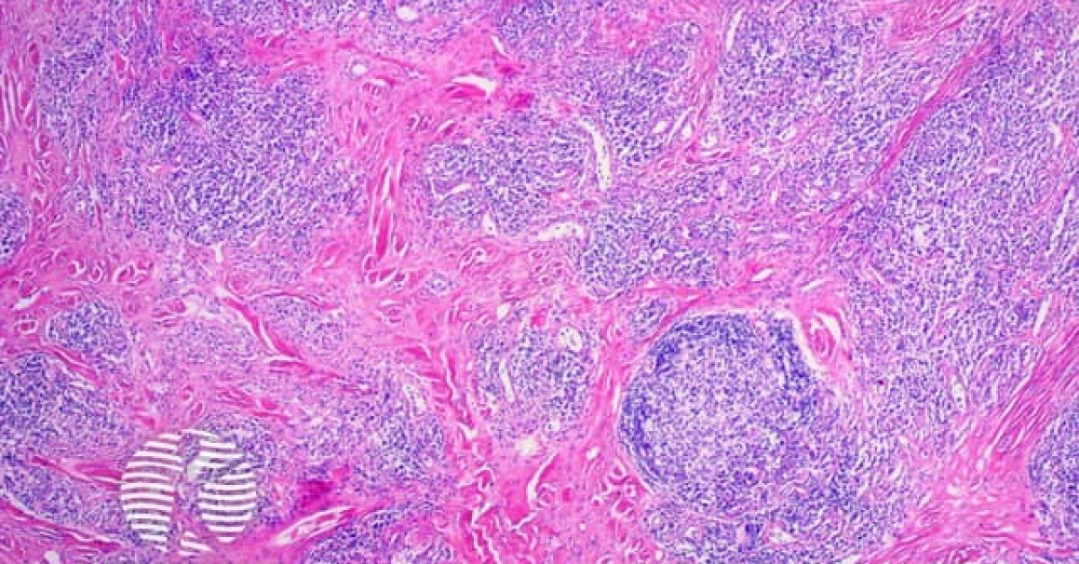 IgG4-related skin disease pathology image