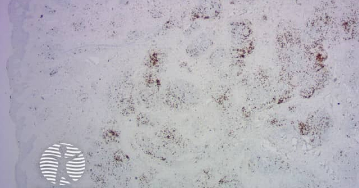 IgG4-related skin disease pathology image