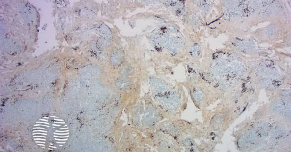 IgG4-related skin disease pathology image