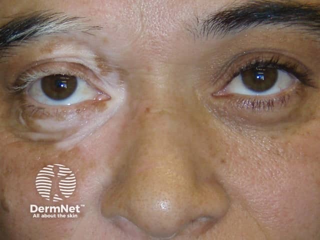 Segmental vitiligo