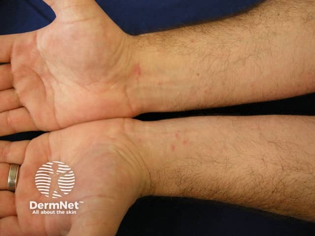 Lichen planus on wrists