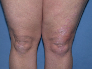 Psoriasis of knees