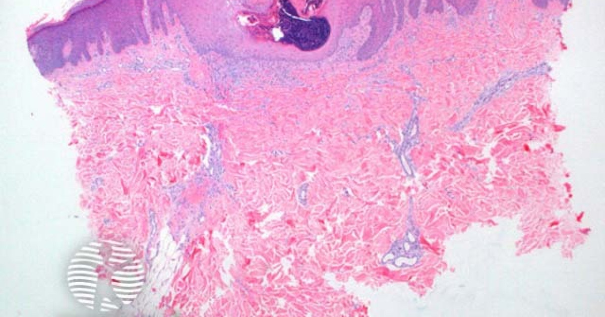 Collagenea Reactive perforating collagenosis pathology image
