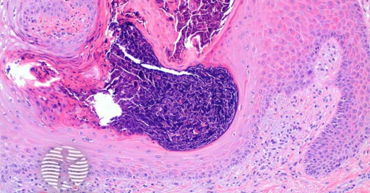 Reactive perforating collagenosis pathology image