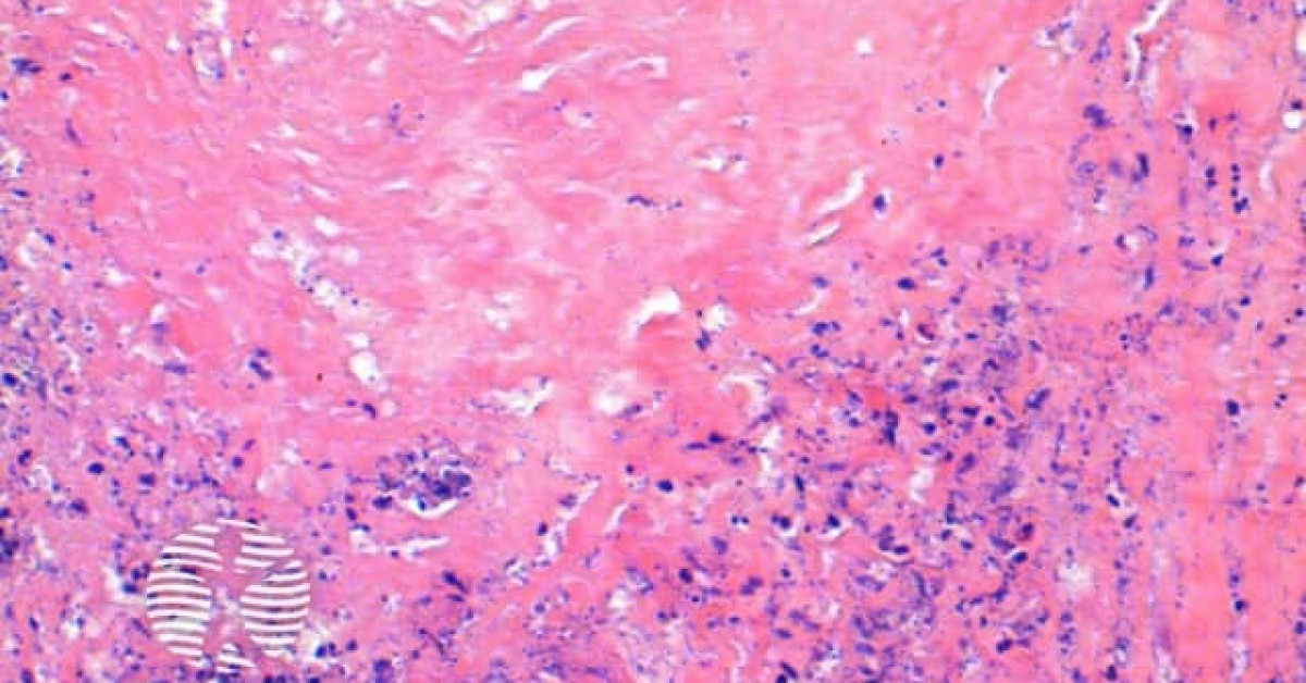 DermNet® - Granuloma annulare pathology image