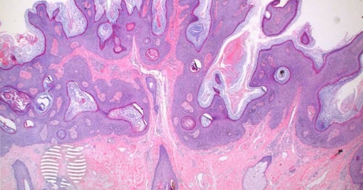 DermNet® - Epidermal naevus pathology image