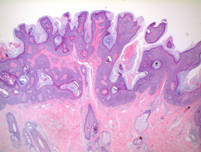 epidermal nevus histology