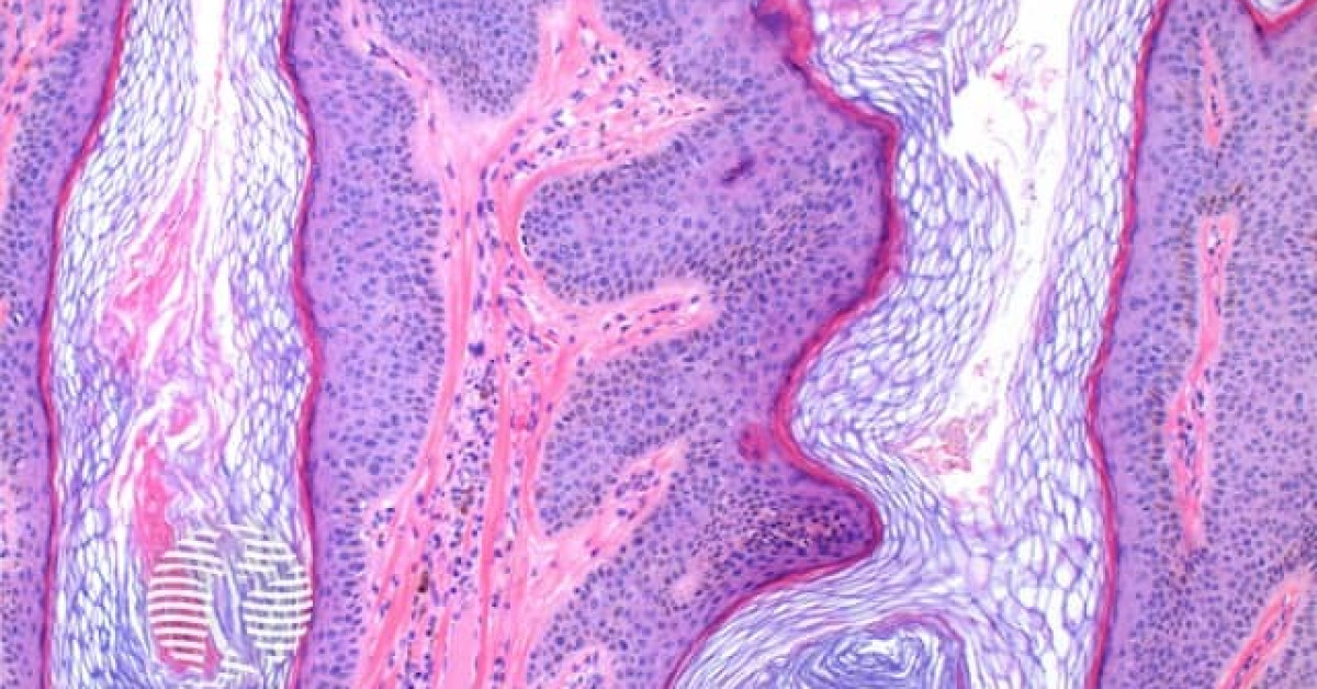 Epidermal naevus pathology image