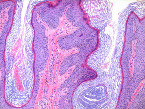 epidermal nevus histology