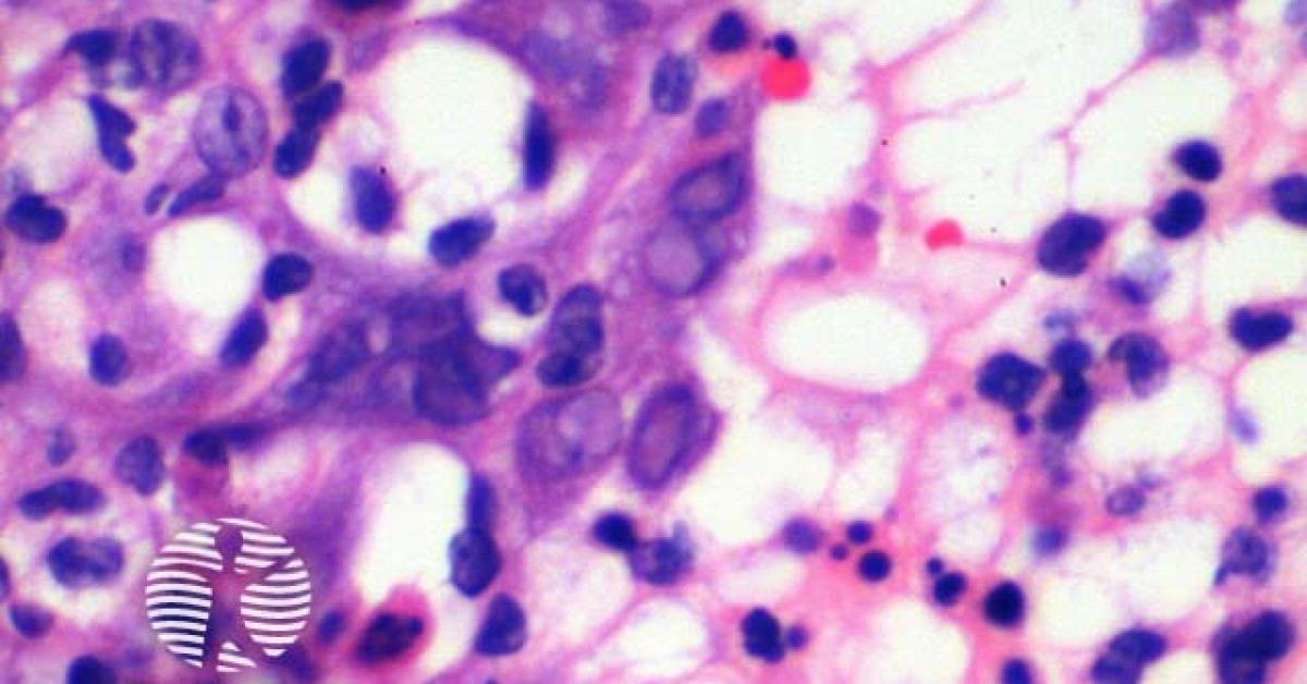 DermNet® - Herpes virus infection pathology image