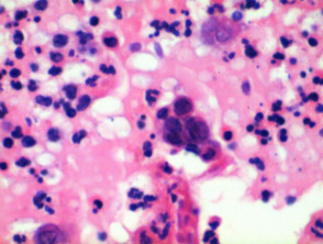 herpetic stomatitis histology