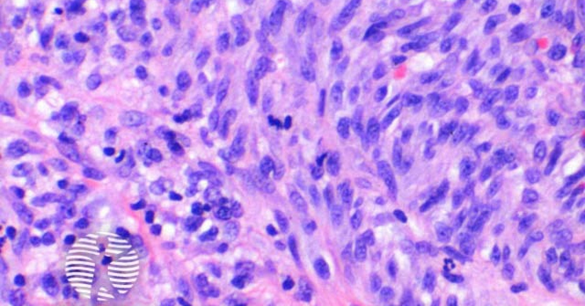 DermNet® - Kaposi sarcoma pathology image