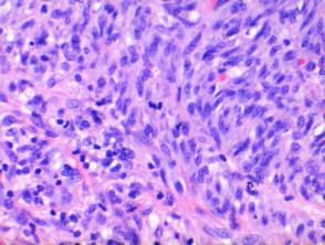 Kaposi sarcoma pathology