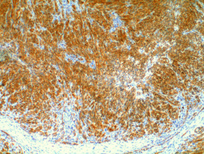 Kaposi sarcoma pathology CD31 stain