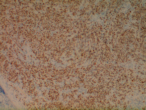 Kaposi sarcoma pathology HHV-8 stain