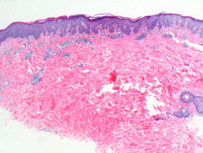 pemphigus erythematosus histology