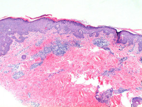 Pemphigus foliaceus pathology