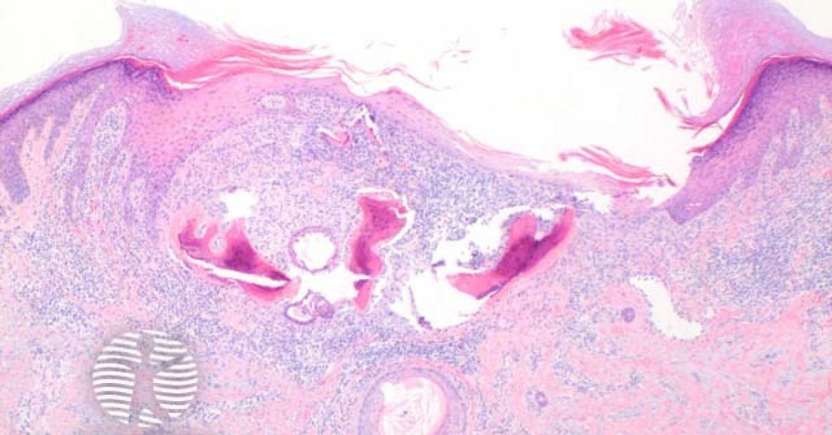 Osteoma cutis pathology image