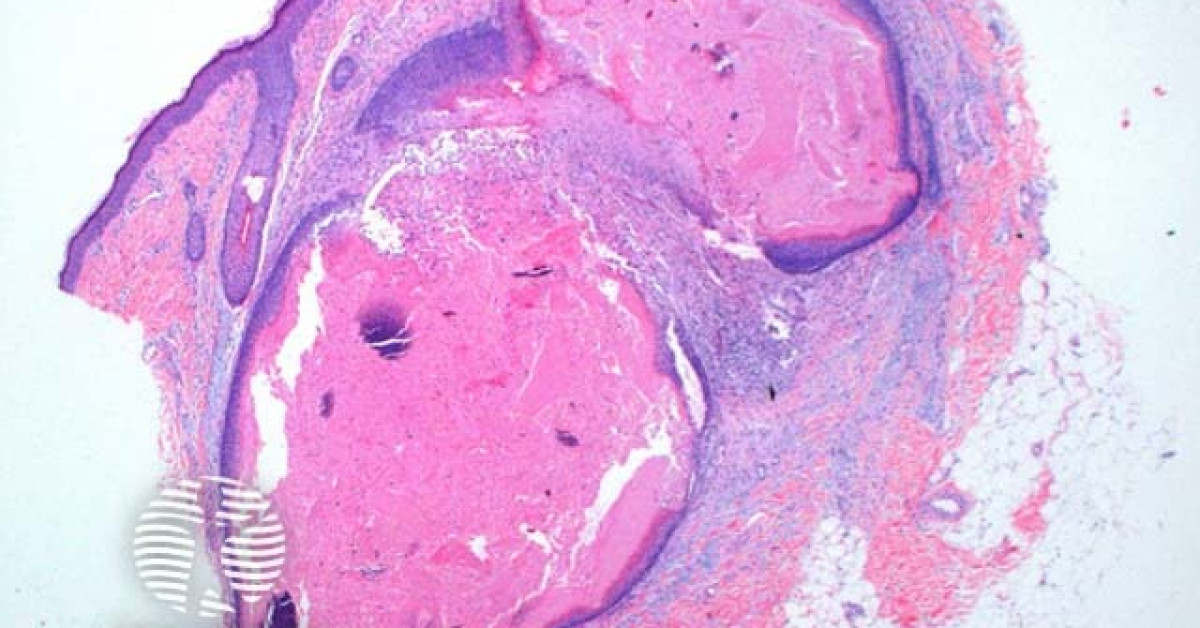 Pilomatricoma pathology image