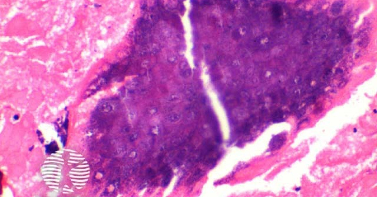 Pilomatricoma pathology image