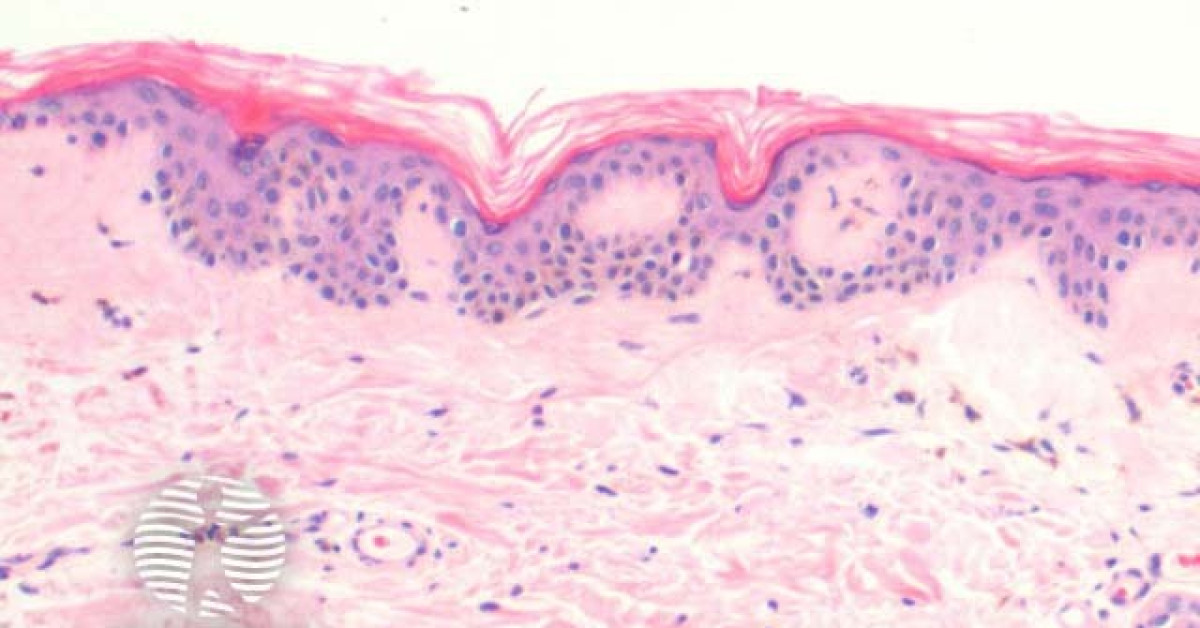 Primary cutaneous amyloidosis pathology image