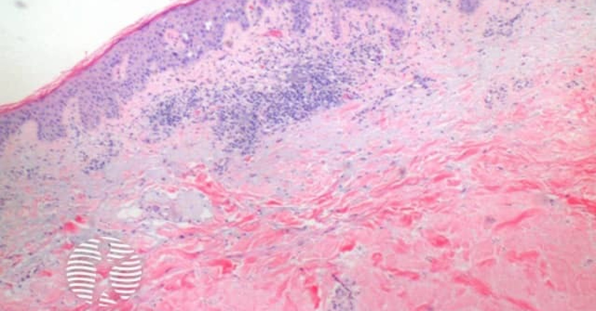 Darier disease pathology image