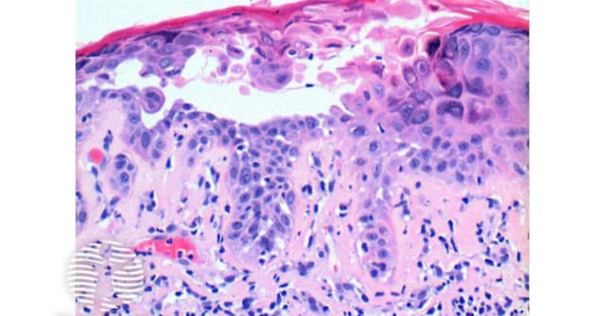 DermNet® - Darier disease pathology image