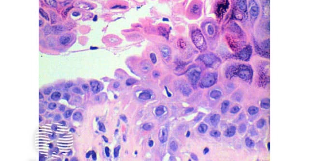 DermNet® - Darier disease pathology image