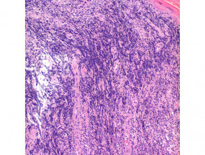 Primary cutaneous diffuse large B cell lymphoma pathology