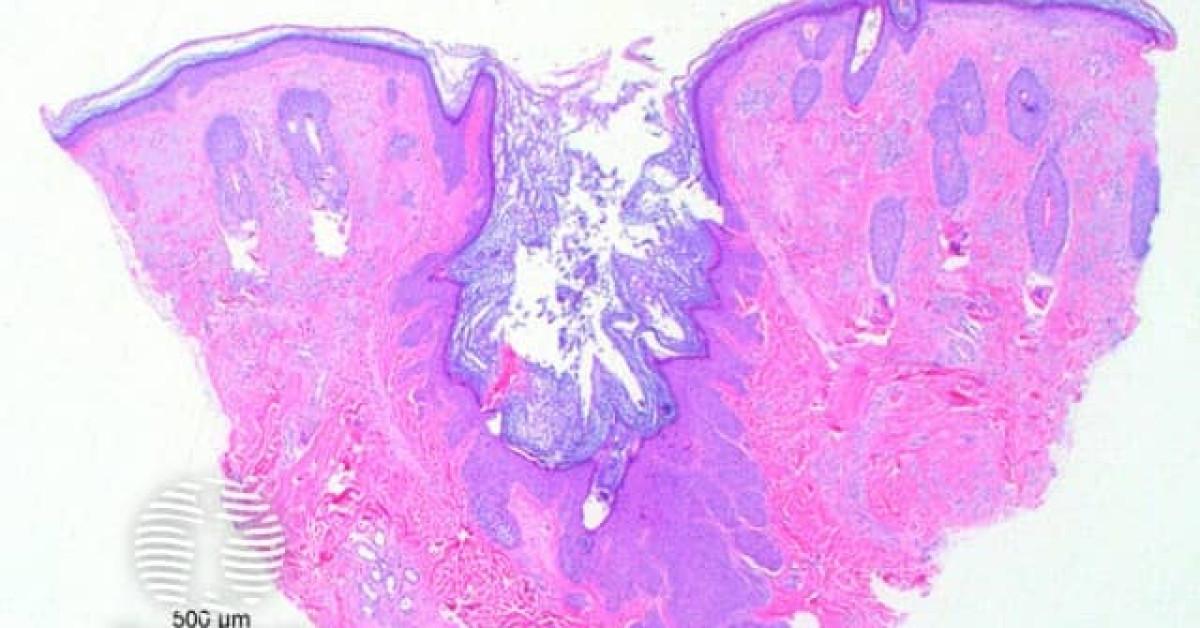 DermNet® - Dilated pore of Winer pathology image