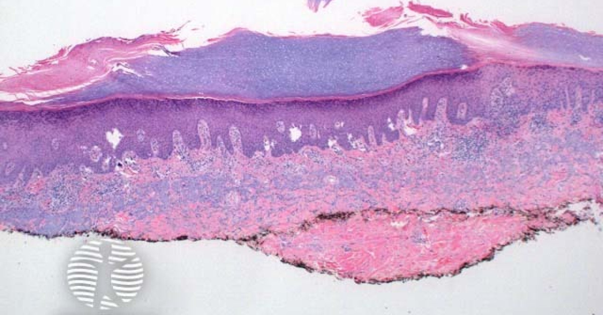 Porokeratosis pathology image