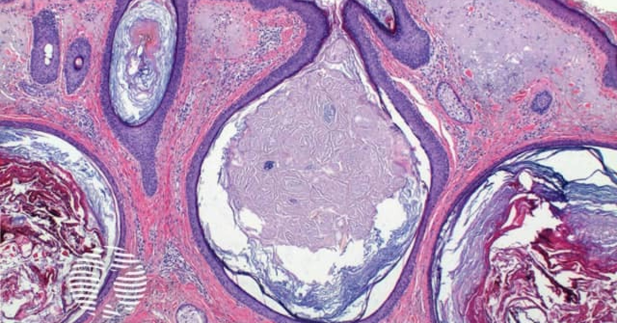Favre-Racouchot syndrome image