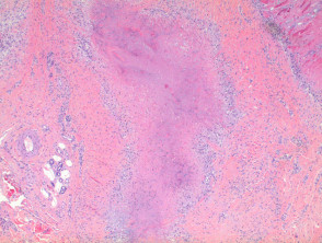 Rheumatoid nodule pathology